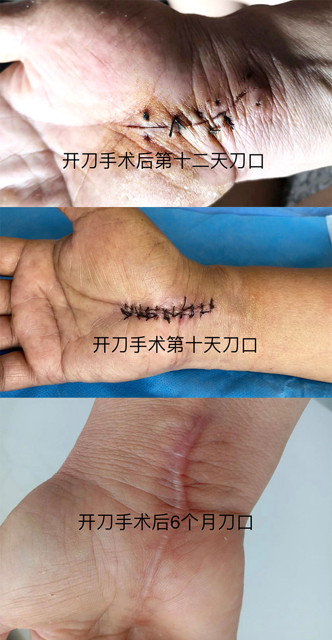 腕管综合征常规开刀手术刀口图