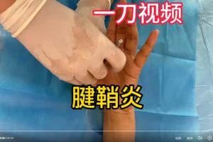 微创手术快速治疗腱鞘炎，魏久驰