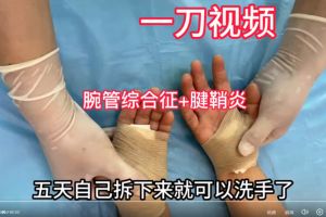 腕管综合征二次手术，魏久驰