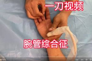 微创手术治疗腕管综合征手麻，魏一刀