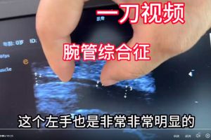 腕管综合征微创手术：一刀开鞘术，魏久驰