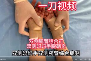 双侧腕管综合征+双侧妈妈手腱鞘炎微创手术：一刀开鞘术，魏久驰