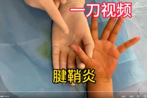 腱鞘炎微创手术：腱纤维鞘切开术，魏久驰