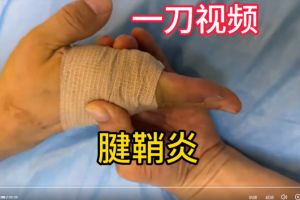 微创手术快速治疗腱鞘炎，魏久驰